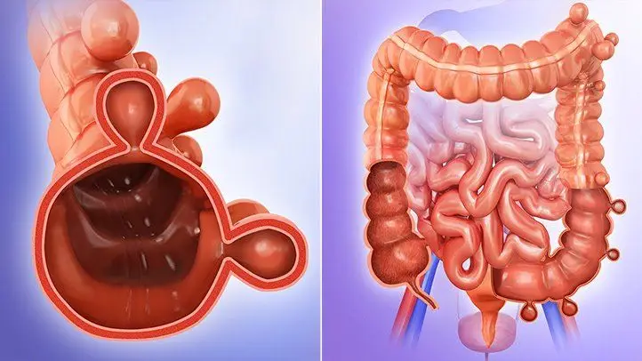 diverticulitis-progression-and-potential-complications-722x406